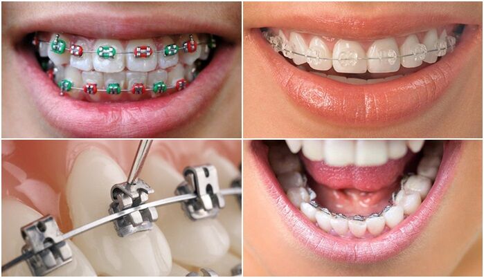 Nên chọn niềng răng loại nào tốt nhất và an toàn hiện nay?