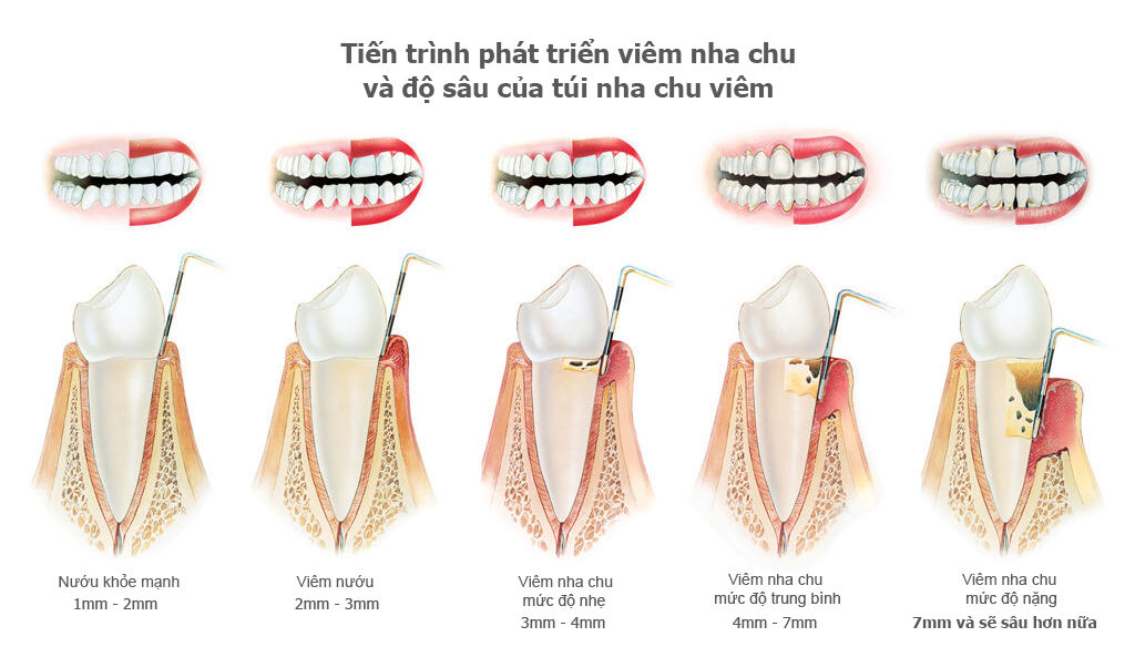 Viêm nha chu