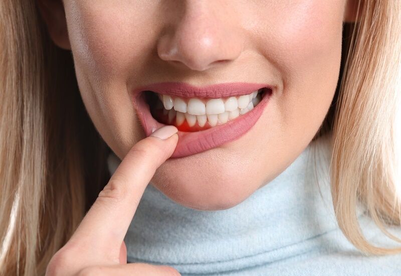 Hướng dẫn phòng ngừa viêm nha chu